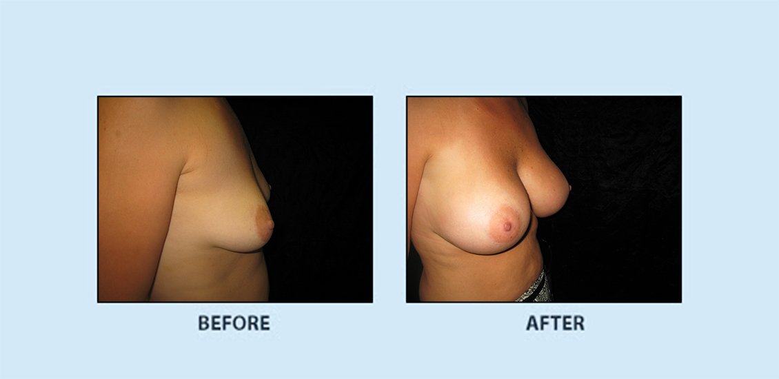 Breast Augmentation10c