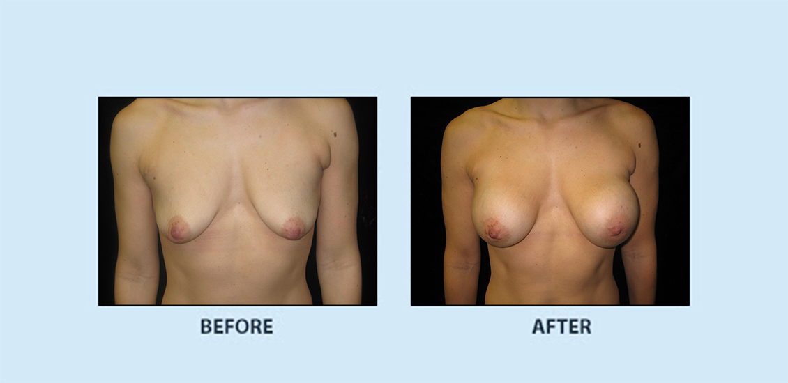 Breast Augmentation11a