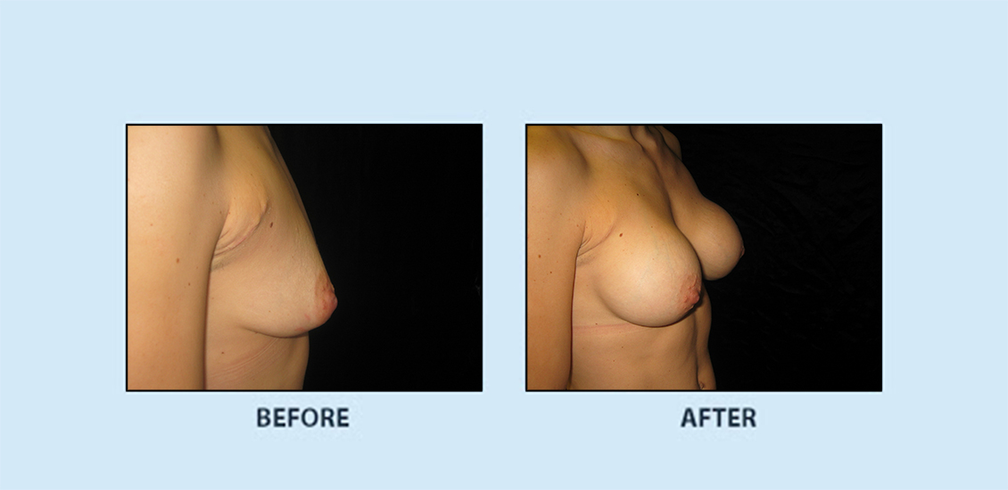 Breast Augmentation11c
