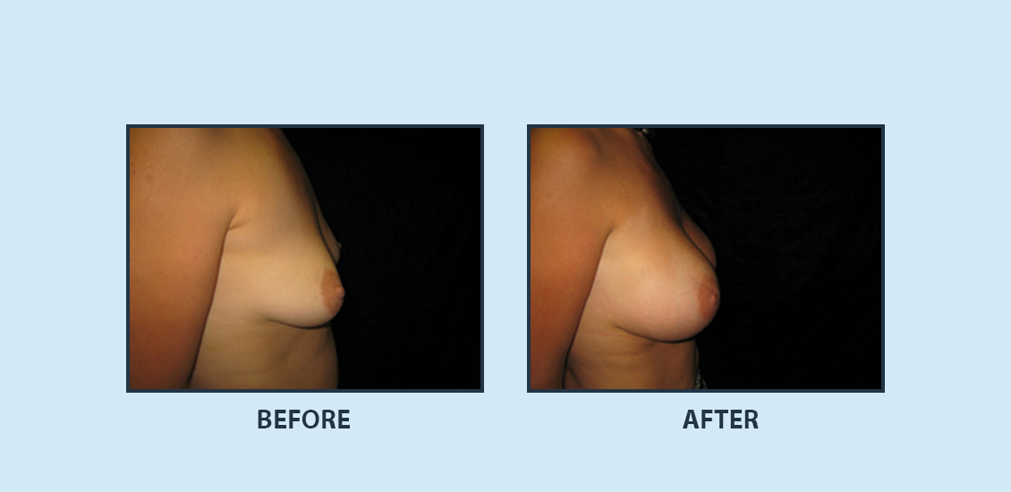 Breast Augmentation3b