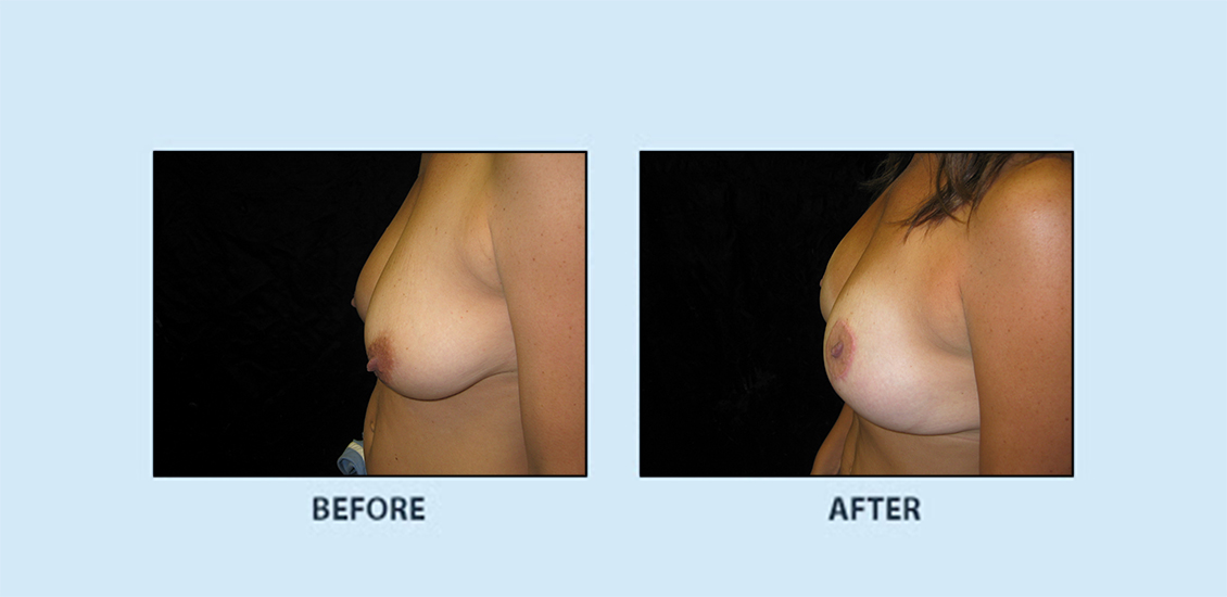 Breast Reduction2b