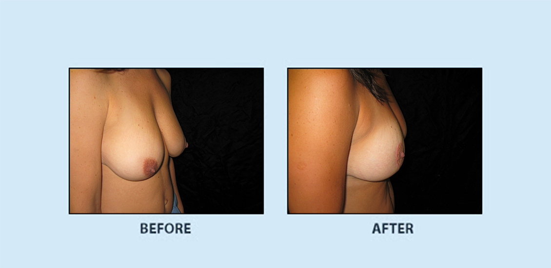 Breast Reduction2c