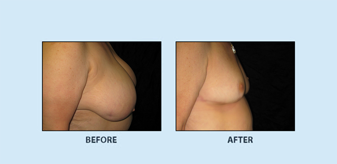 Breast Reduction3c