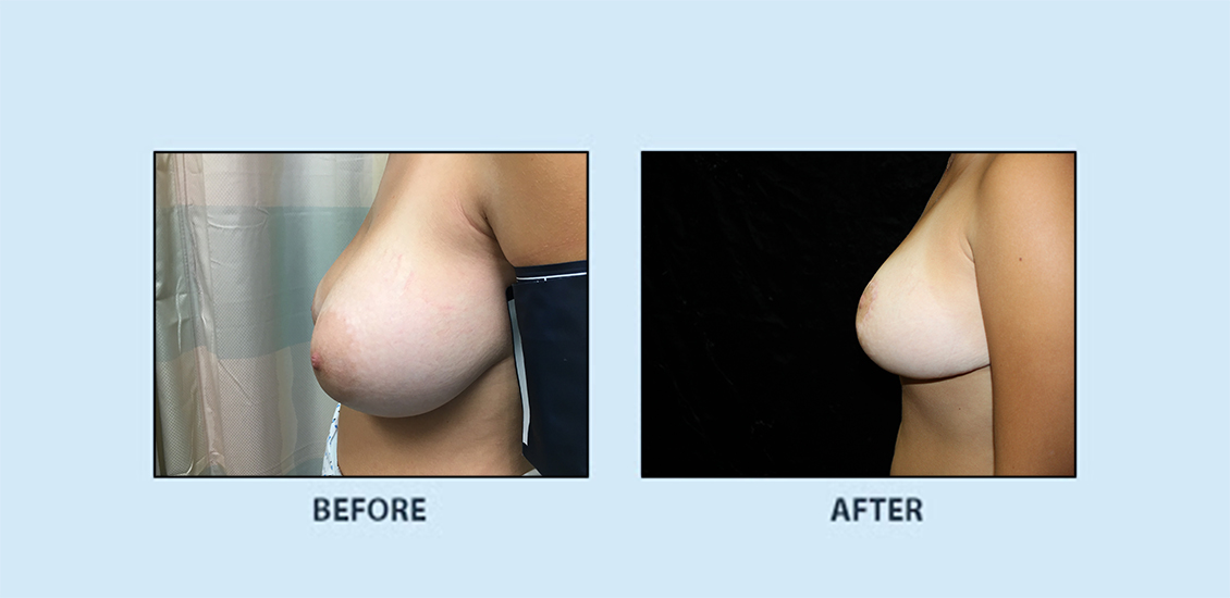 Breast Reduction4b