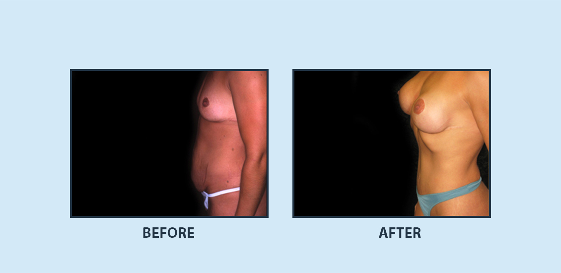 Liposuction3b