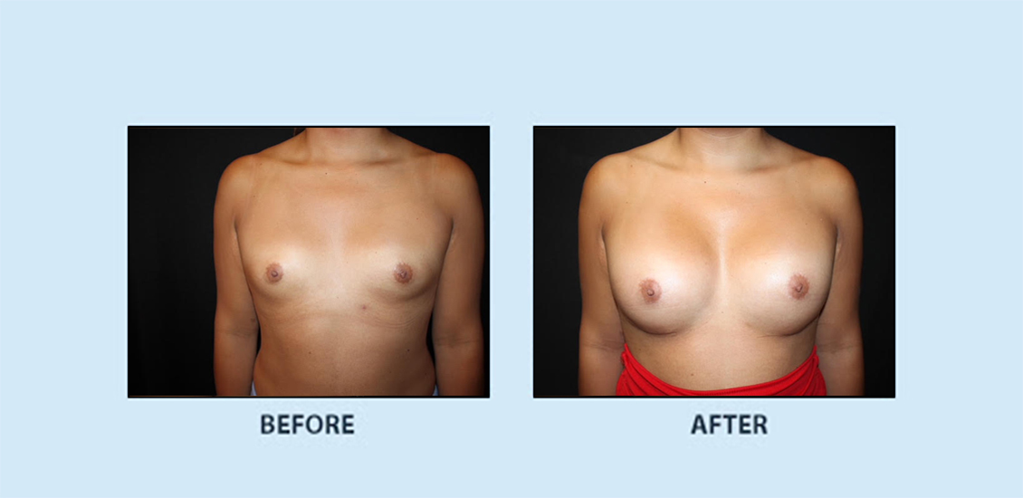 breast_augmentation_5a