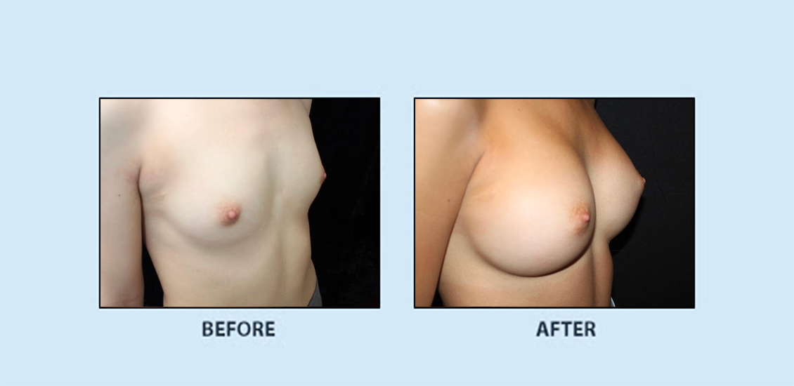 breast_augmentation_6c
