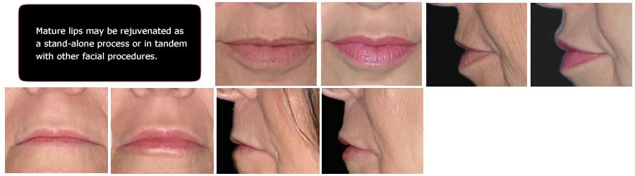008-mature-lips-rejuventaion