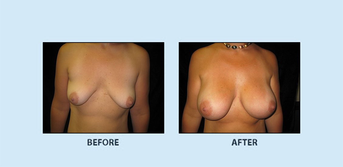 Breast Augmentation10a
