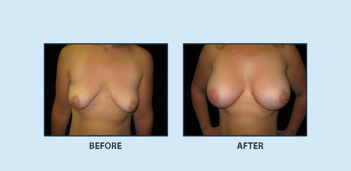 Breast Augmentation3a