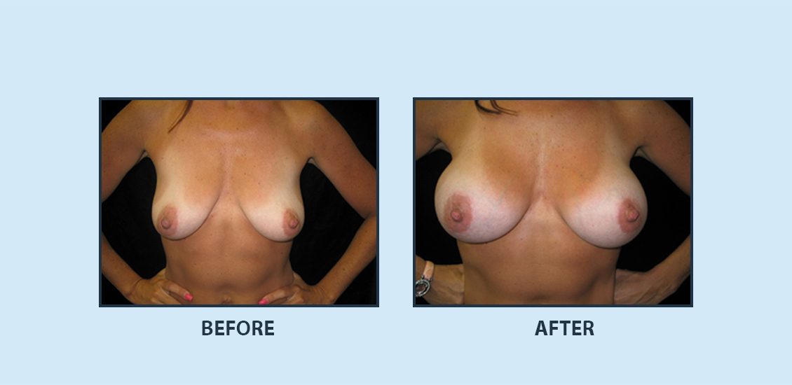 Breast Augmentation4a