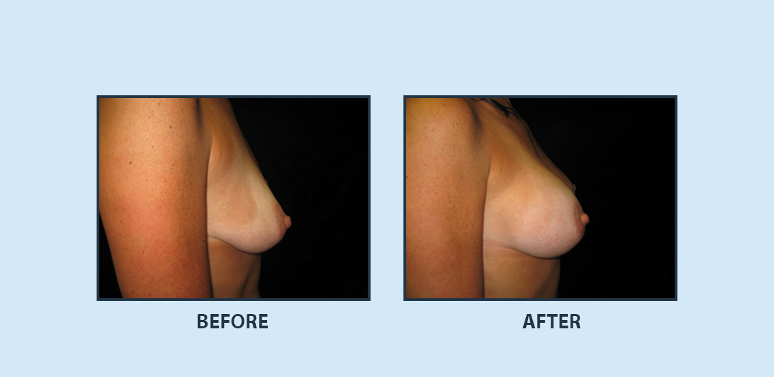 Breast Augmentation4b