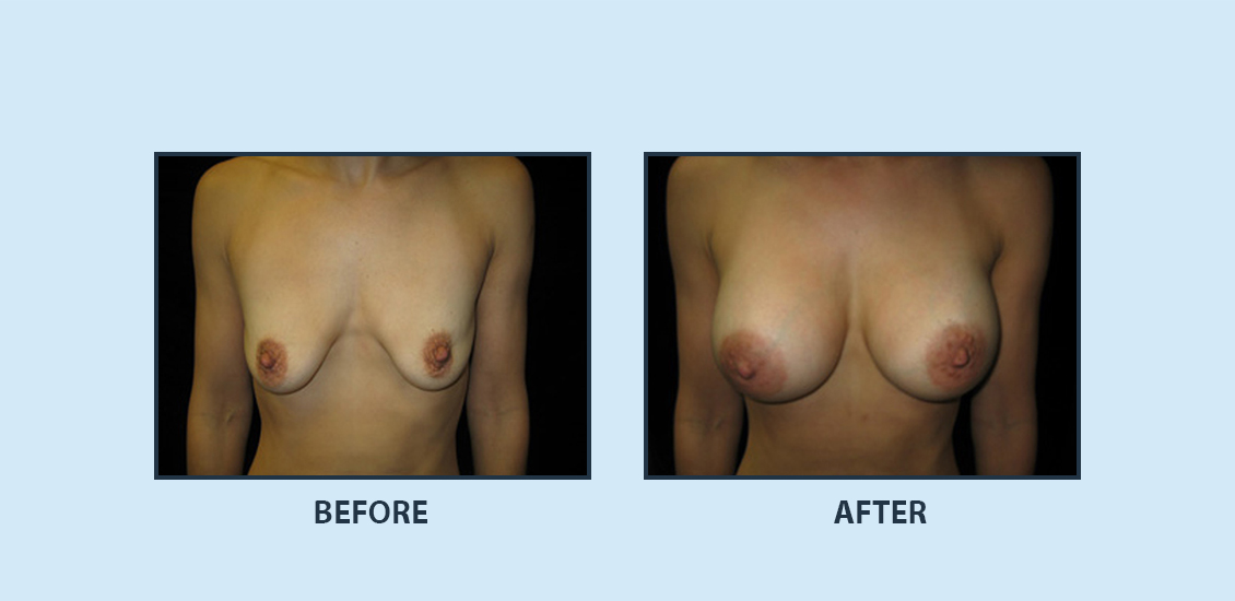 Breast Augmentation7a
