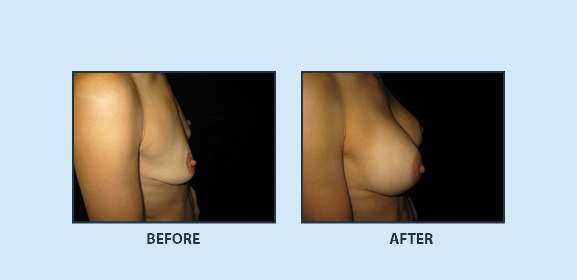 Breast Augmentation7b