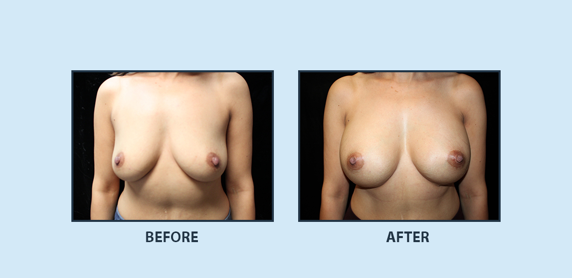 Breast Augmentation8a