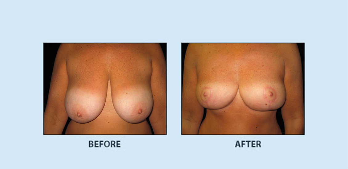 Breast Reduction1a