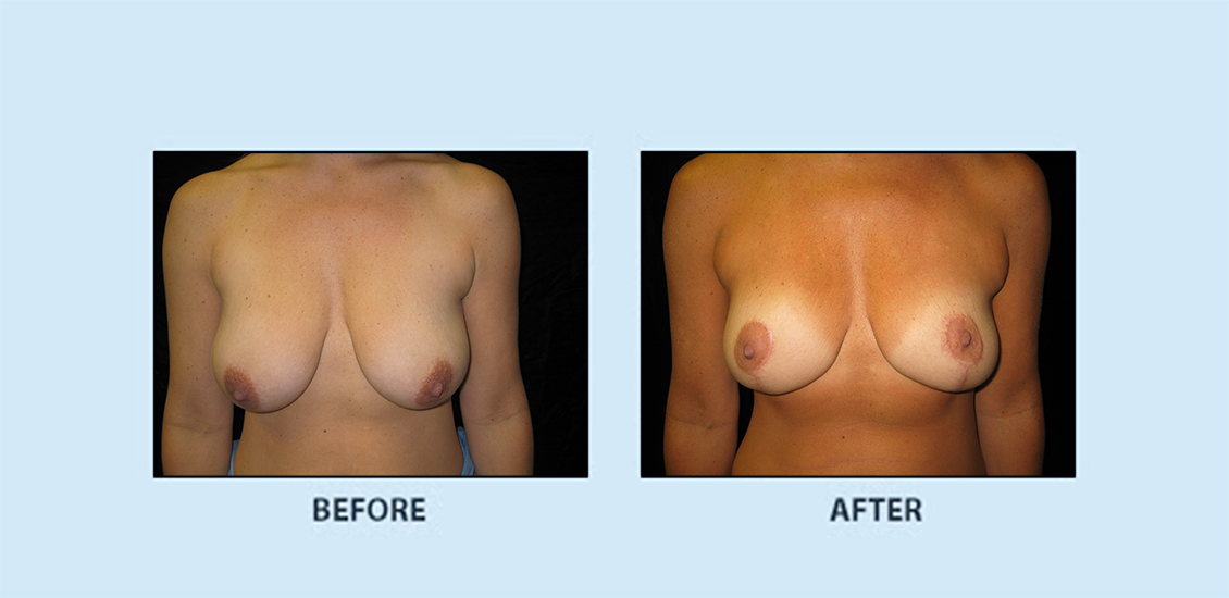 Breast Reduction2a