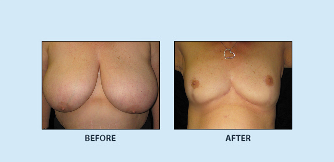 Breast Reduction3a