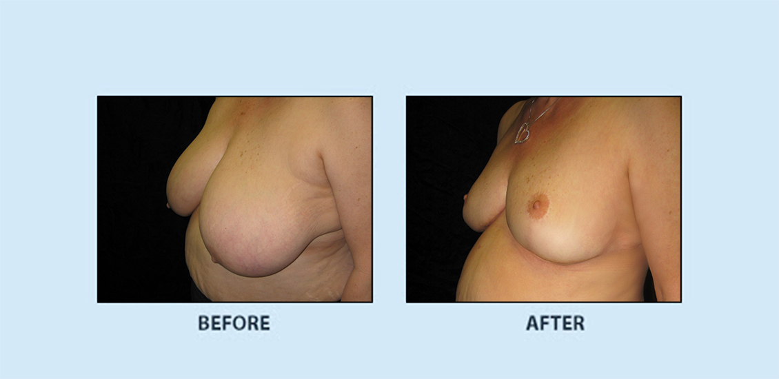 Breast Reduction3b