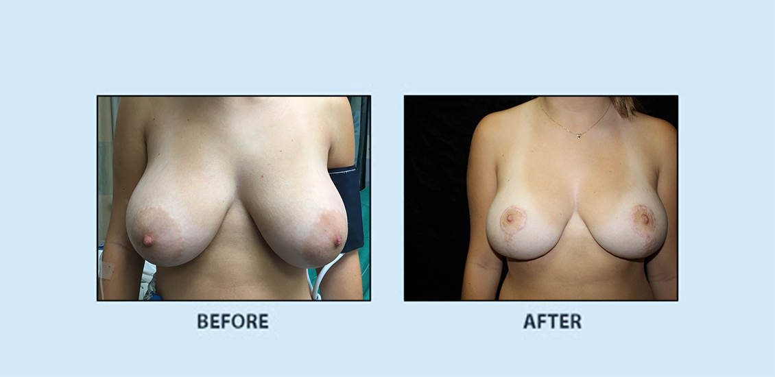 Breast Reduction4a