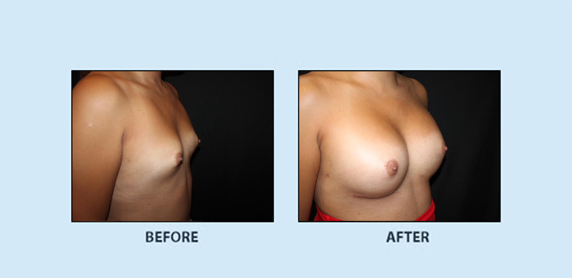 breast_augmentation_5c