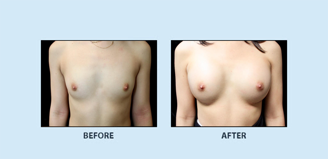 breast_augmentation_6a