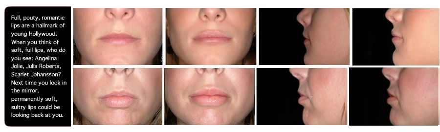 004-perma-facial-augmented-lips