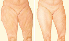 Thigh Lift Cosmetic Surgery in Morgantown, WV and surrounding